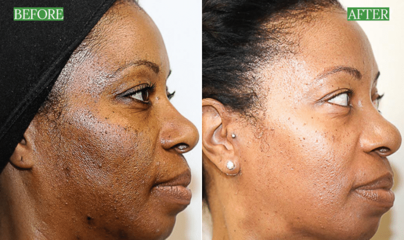 Masque LED Visage LumifySkin - Thérapie Lumière Rouge Anti-Âge